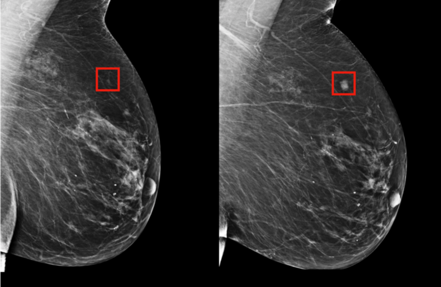 Revolutionary AI Technology Transforms Breast Cancer Prediction with Personalized Care Strategies