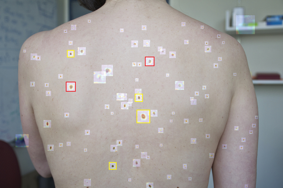 Revolutionary AI-Powered System Transforms Early Melanoma Detection Using Smartphone Technology